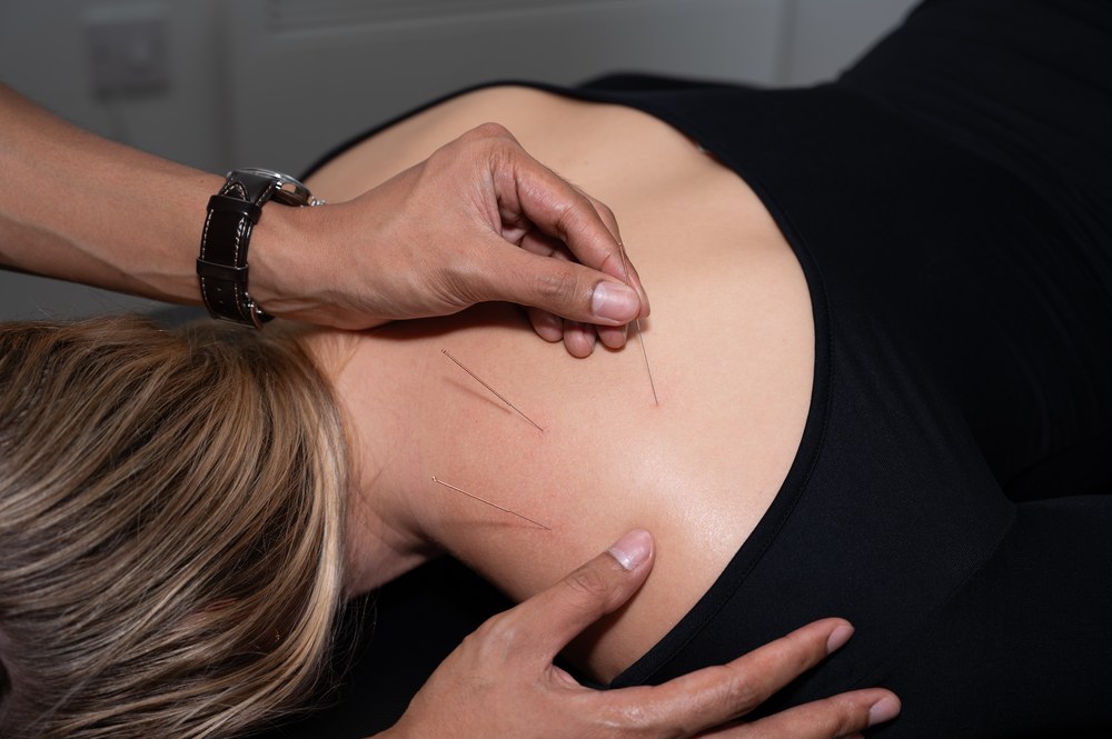 AACP-accredited medical acupuncture being applied to a patient's upper back in Birmingham